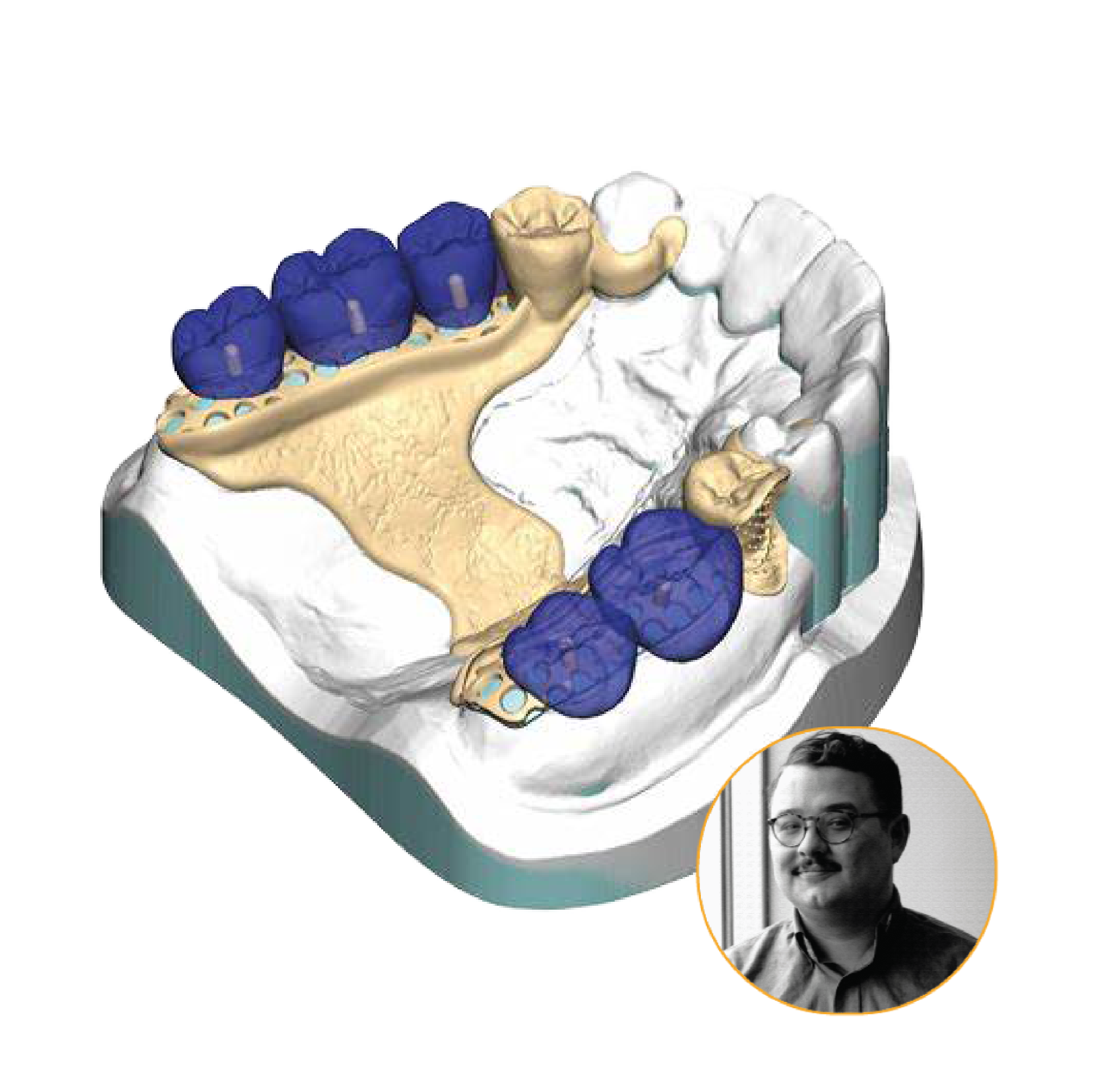 Partial Denture | Evolve Dentistry